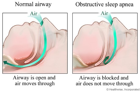 obstructive-sleep-apnea-holistic-dentistry