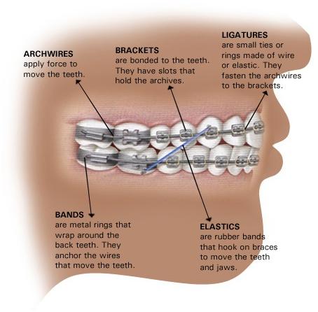 Braces Diagram braces_diagram