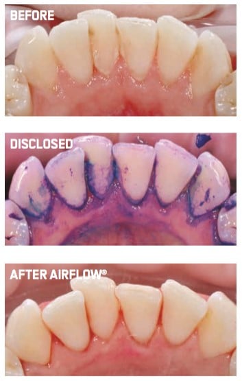 Guided Biofilm Therapy