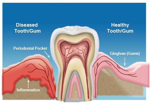 Gum Disease gum_disease