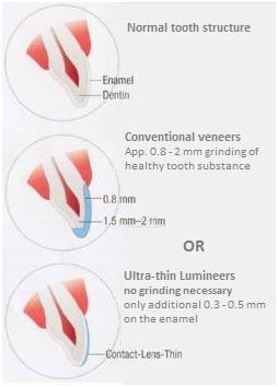 Lumineers Lumineers_vs_Veneers