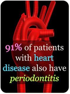 Periodontis Heart periodontis-heart
