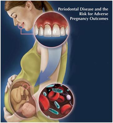 pregnancy-gum-disease