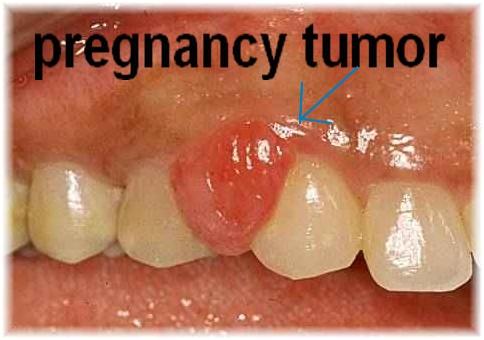 pregnancy tumor