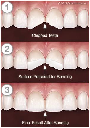 Composite Bonding tooth-bonding-process